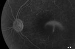 Corioretinopatie Seroasa Centrala Medoptica